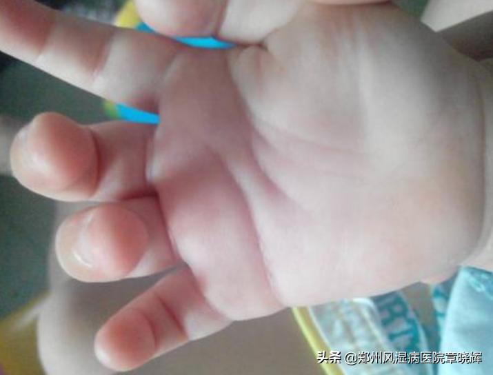 儿童类风湿的4个征兆,儿童得类风湿性关节炎严重吗