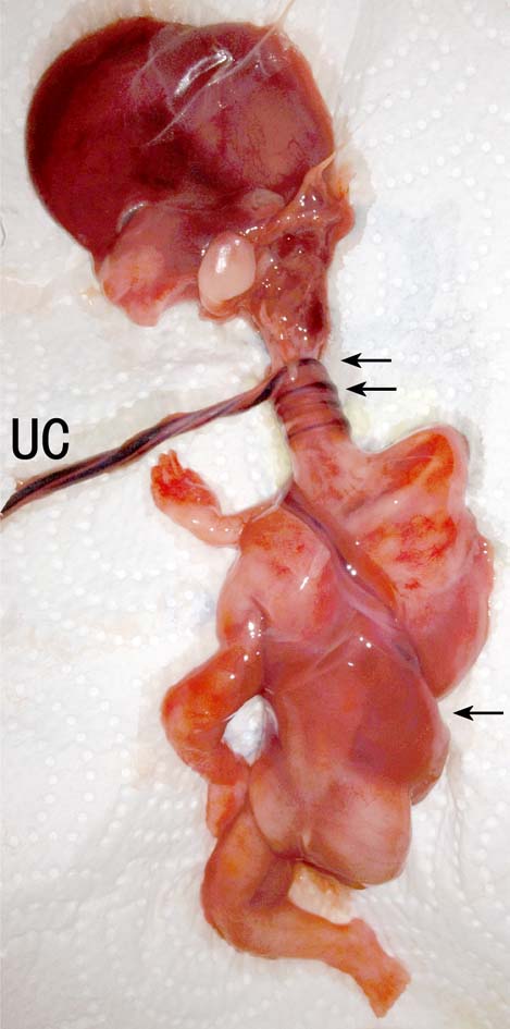 脐带过长超声诊断,脐带过长或过短能检查出来吗