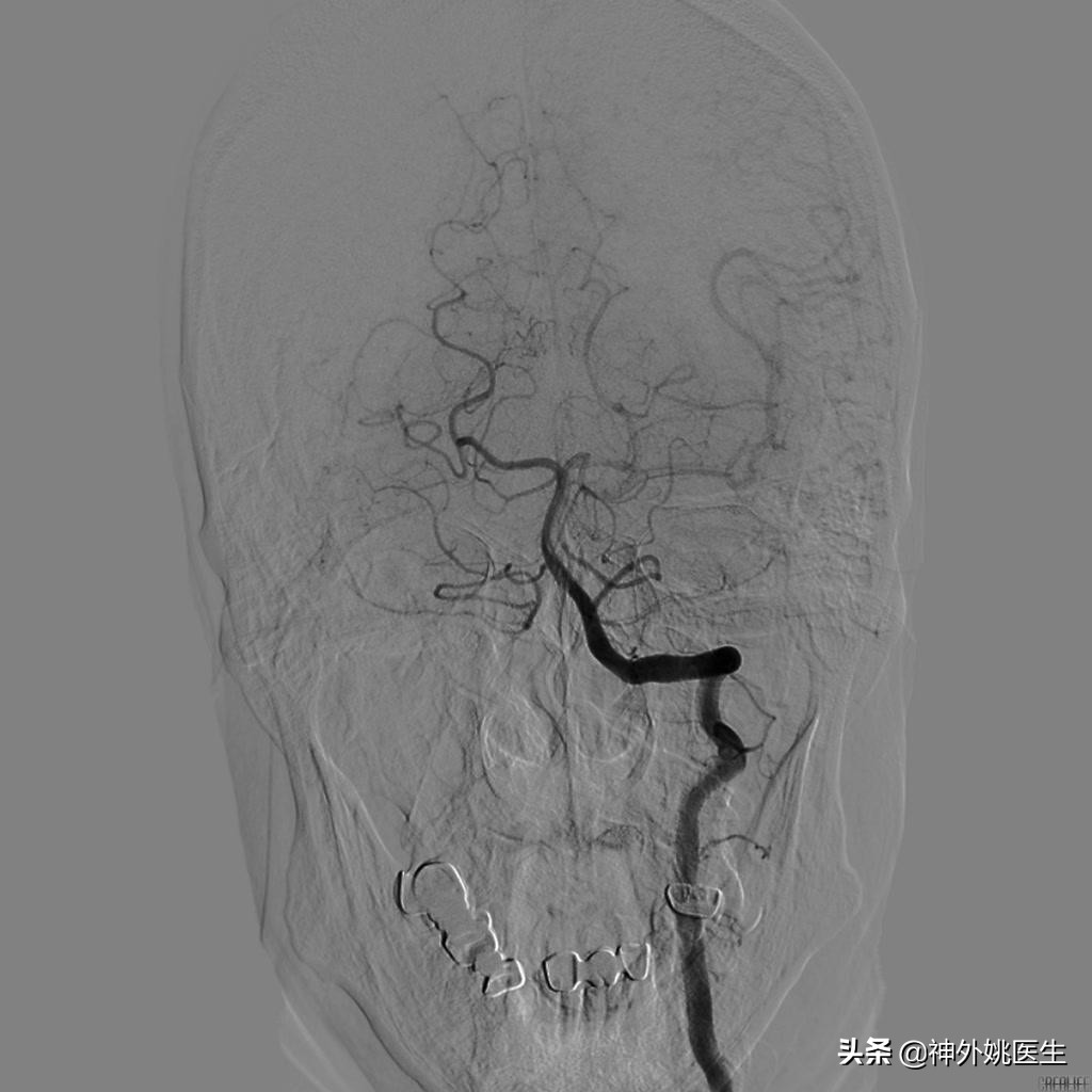 颈动脉狭窄的外科治疗