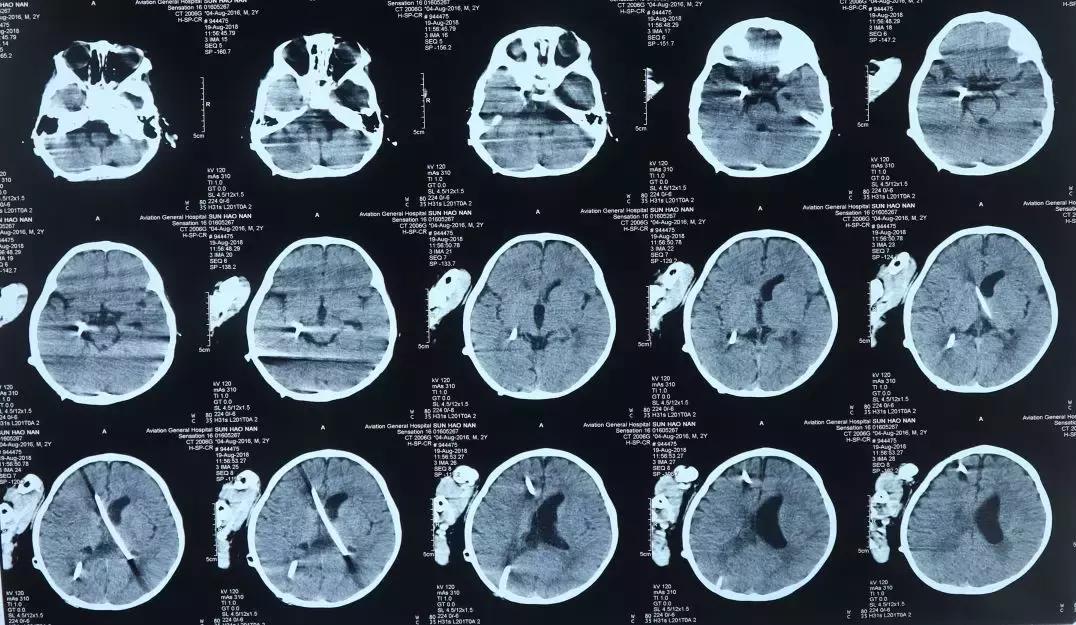 孩子脑积水反复发烧,婴儿脑积水引起发烧如何保守治疗
