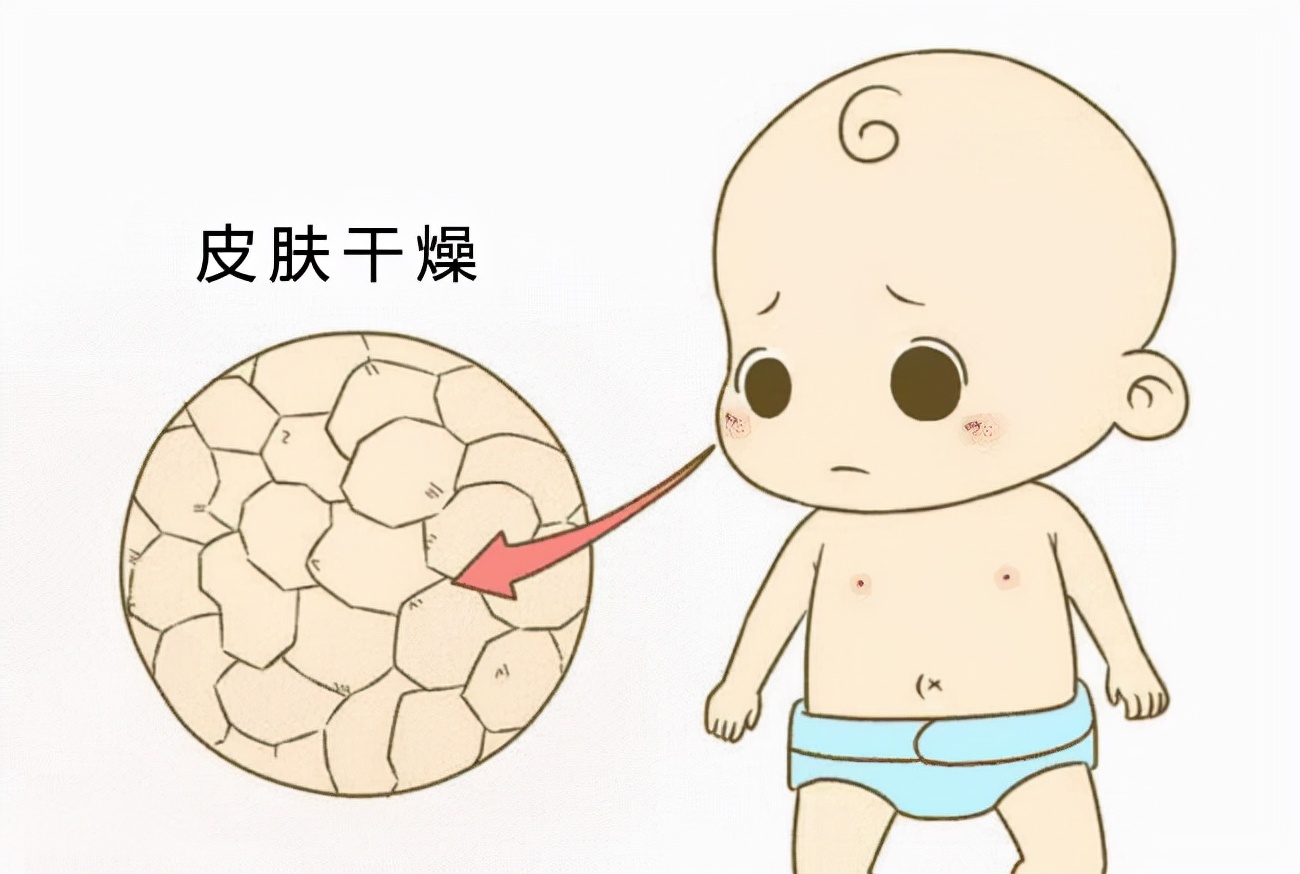 新生儿照蓝光后皮肤干燥怎么办,新生儿皮肤干燥裂口怎么回事呢