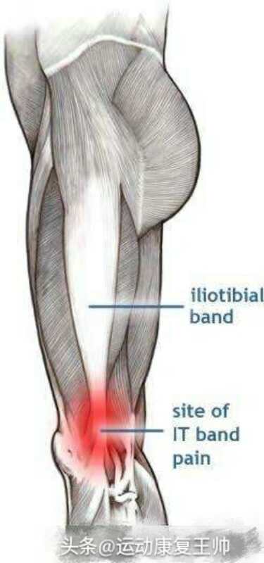 跑步膝如何判断是否康复,跑步膝康复练习法