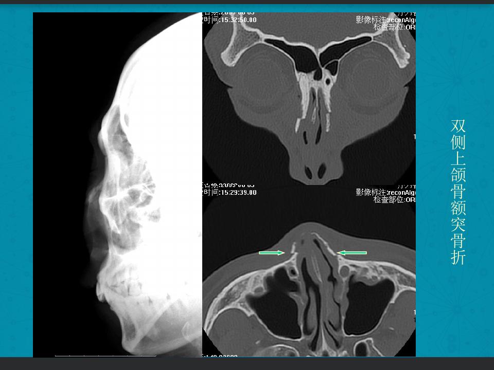 鼻骨骨折复位全过程,诊断证明鼻骨骨折问号是什么意思