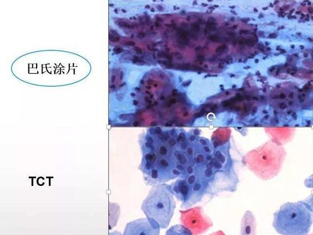 hpv检查e6和e7阳性会影响怀孕么,hpv核酸检测和e6e7检测有什么区别