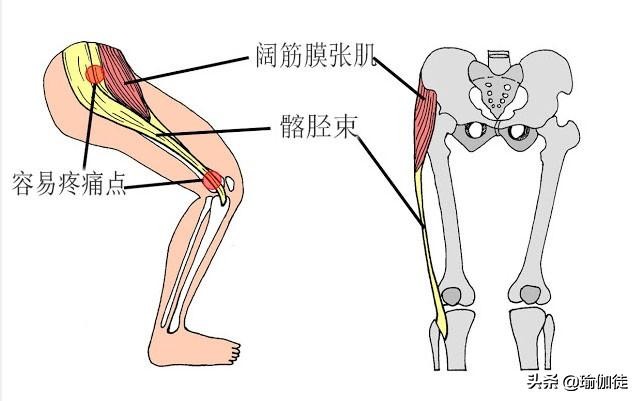 阔筋膜张肌引起臀部疼痛,怎样快速治疗阔筋膜张肌