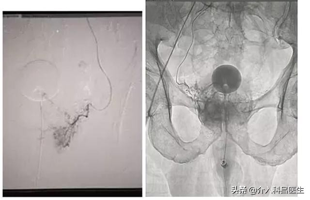前列腺介入栓塞术和电切的区别,前列腺增生介入治疗