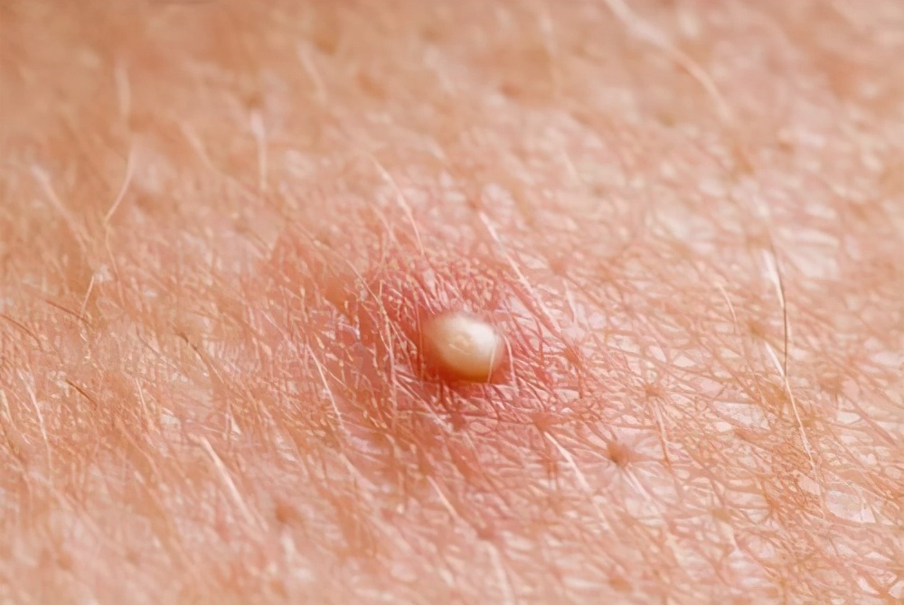 痘痘不挤影响愈合,痘痘不能挤为什么还针清