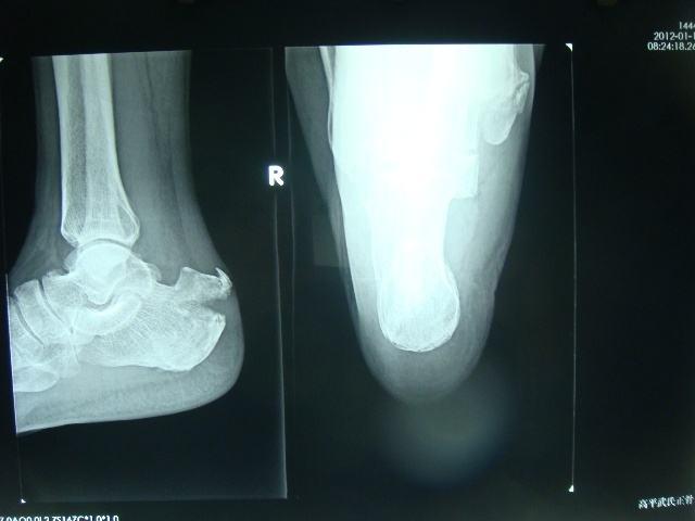 脚骨折后多久可以康复训练,跟骨粉碎性骨折50天医生叫我走路