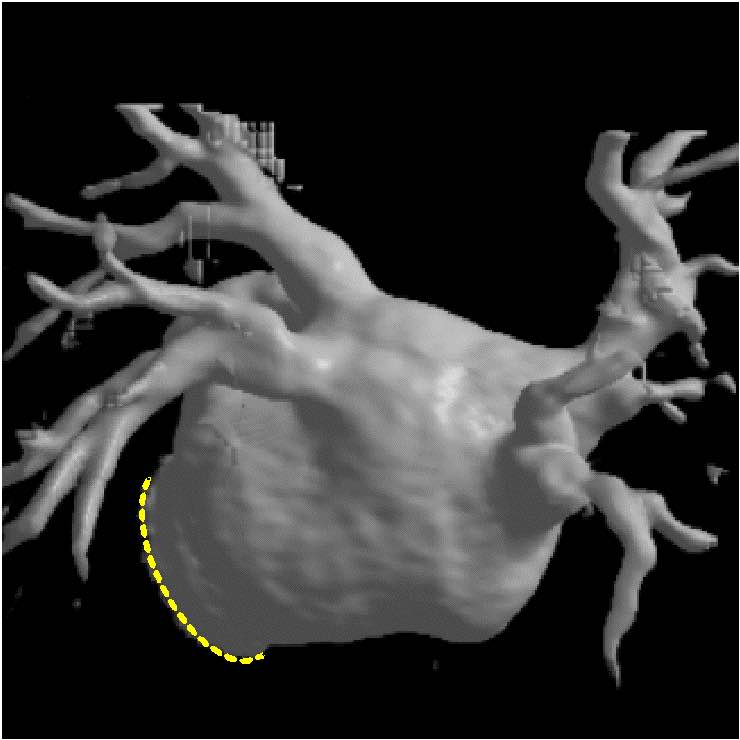 房颤的射频消融,房颤的射频消融从什么血管进入