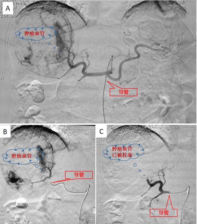血管栓塞术治疗肿瘤,血管介入栓塞治肿瘤