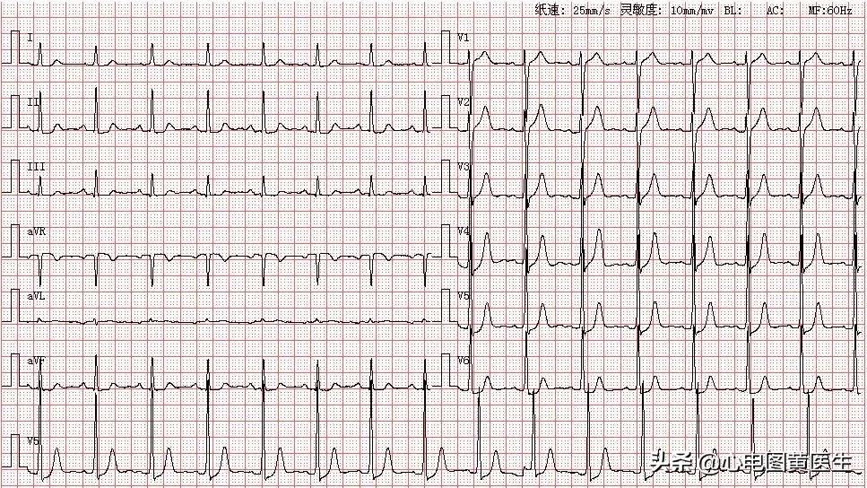 心电图左室高电压t波改变,心电图显示左室高电压和t波改变