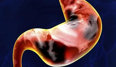 糜烂性胃炎真的是胃烂了嘛,糜烂性胃炎胃食道反流原因