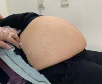 15岁少年腹中20公斤巨瘤,39岁女子腹中30斤巨型肿瘤