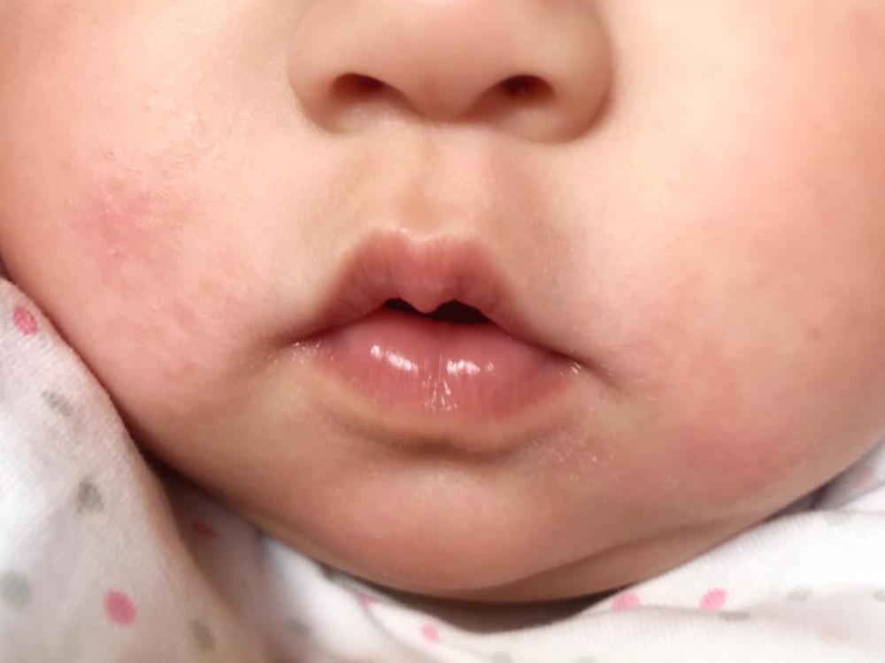 宝宝出口水疹是什么症状,婴儿口水疹症状及治疗方法