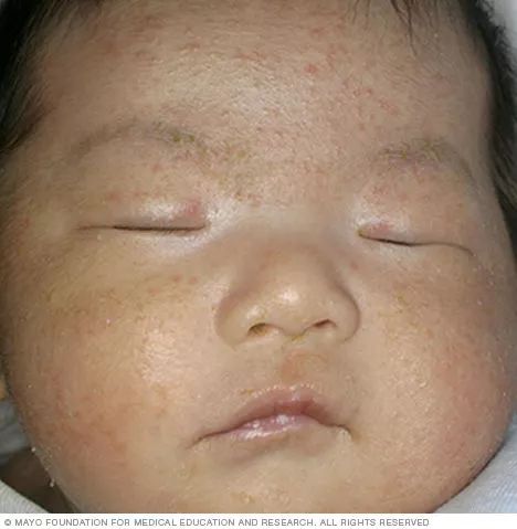 宝宝疹子怎么解决,宝宝疹子是怎么引起的