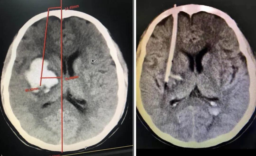泉州：突破！永春县总医院成功开展新技术