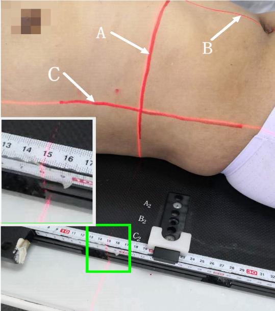 放疗十字线标记图解,放疗身上画的线图片