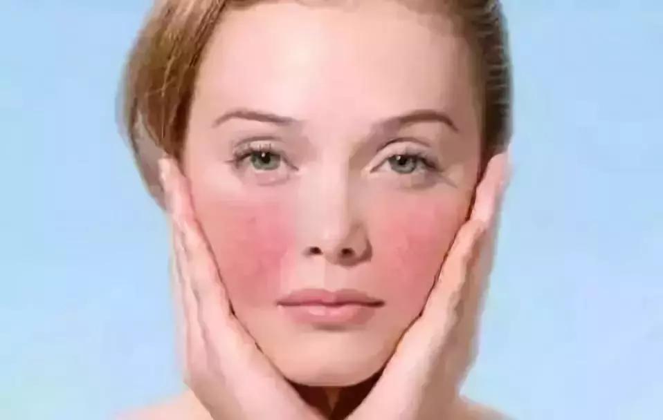 脸颊反反复复长痘就是有炎症,脸上像打了腮红一样是什么原因