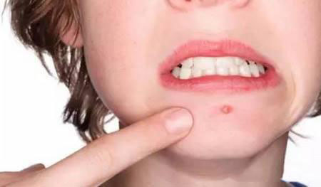 怎么预防脸上长痘痘,怎么预防孩子大了长痘痘