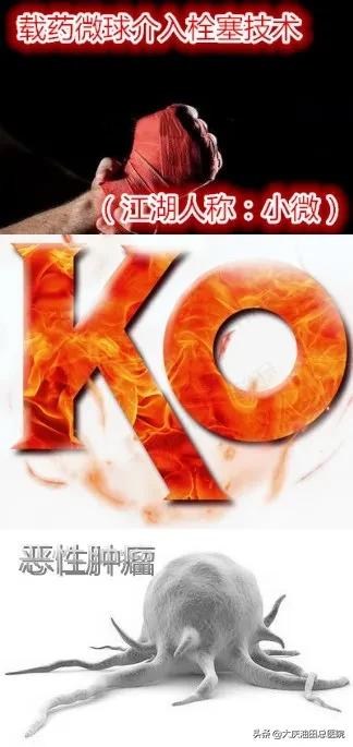 微创介入手术从哪年开始的,介入微创手术成功率和后遗症