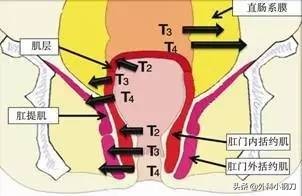 鍖荤敓鍓叉帀澶ц偁,鑲涢棬鍒囬櫎鍚庣画娌荤枟