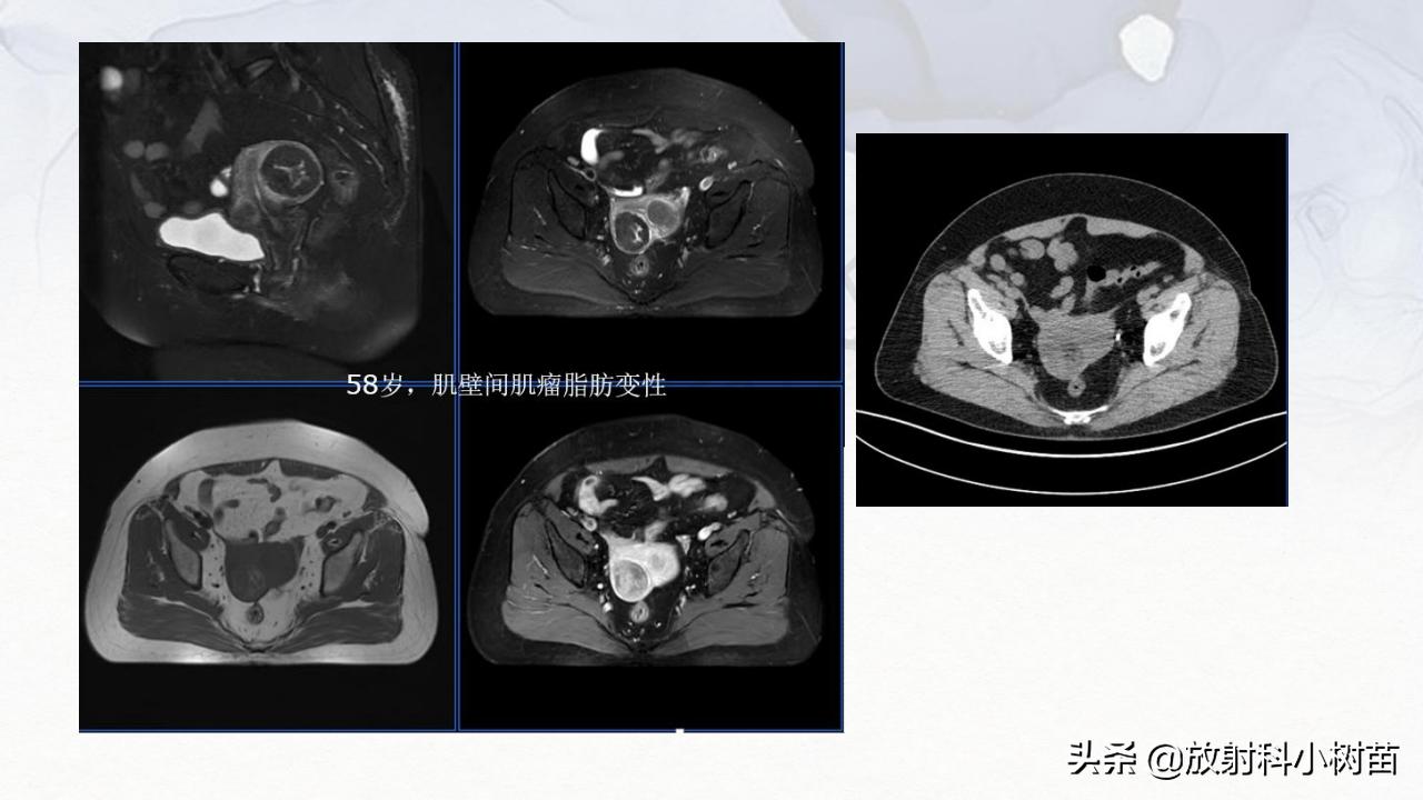 女性盆腔mri解剖图谱,泌尿生殖系统x线解剖