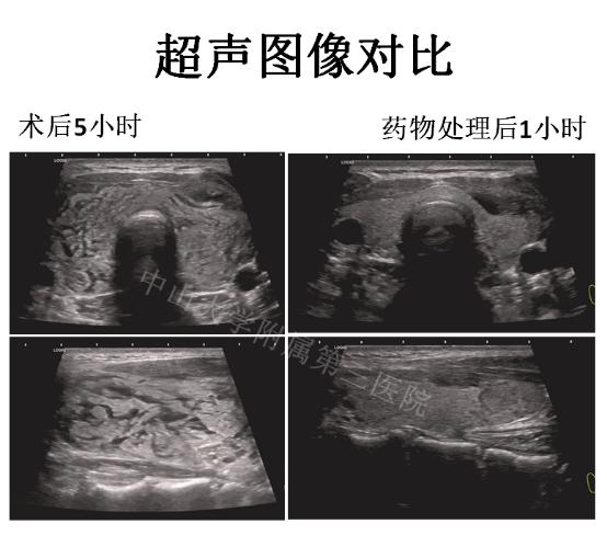 做完甲状腺穿刺后,脖子像吹气球一样肿起来?专家带你剖析原因