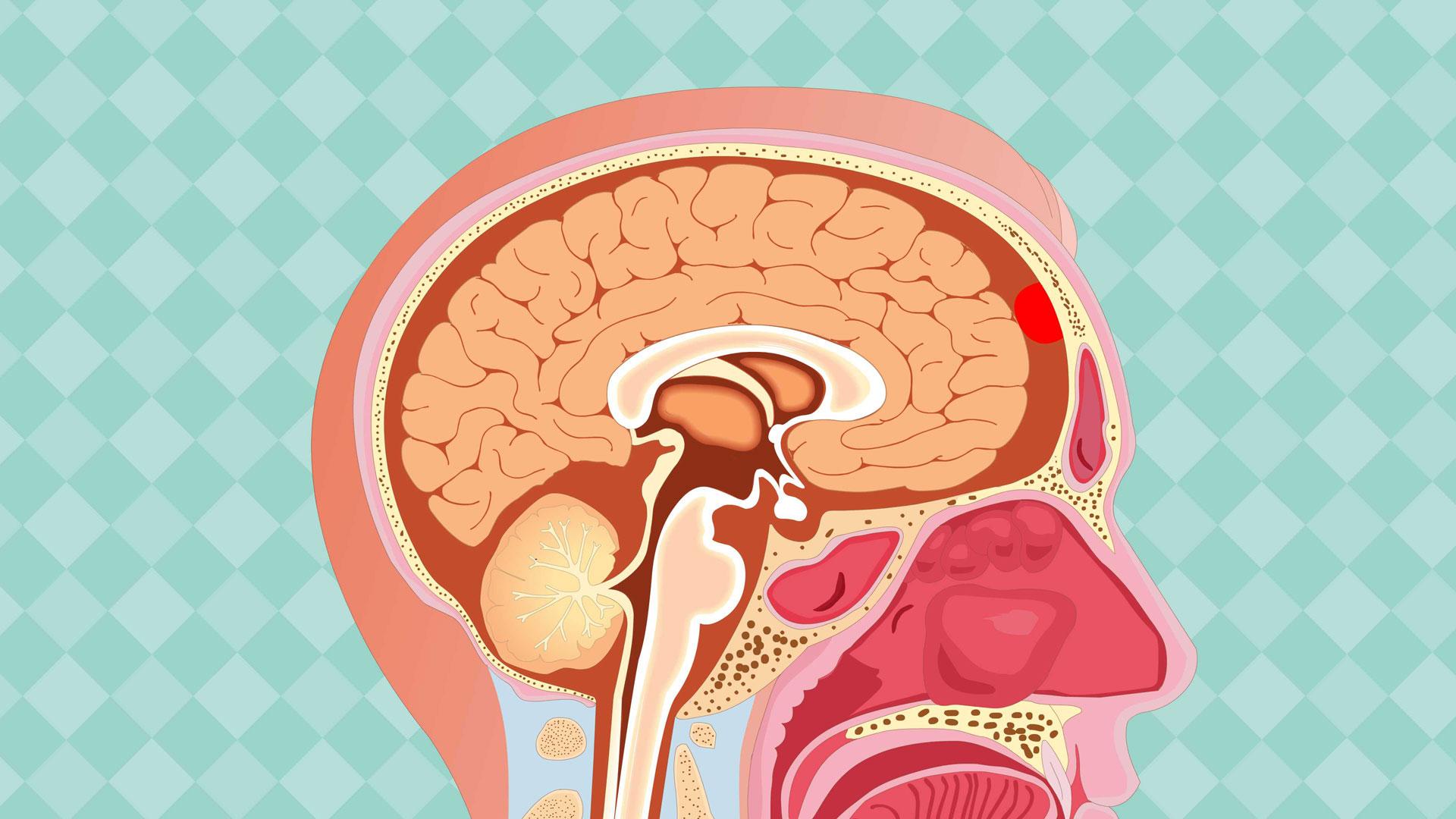 鞍结节脑膜瘤误诊为垂体瘤,鞍结节脑膜瘤发病原因