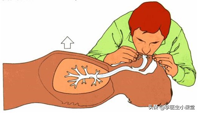 医生抢救心梗10秒自救方法,如果有突发性心梗该怎么急救