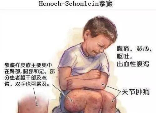过敏性紫癜用药多久后症状能缓解,儿童过敏性紫癜的症状什么引起的