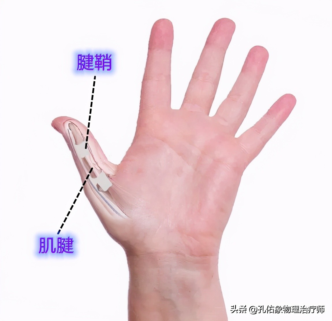 中年人患腱鞘炎怎么治,中老年腱鞘炎特效药