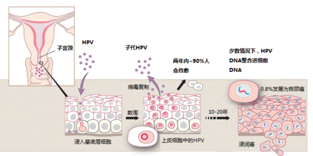 宫颈癌最深度解读,宫颈癌筛查报告正确解读