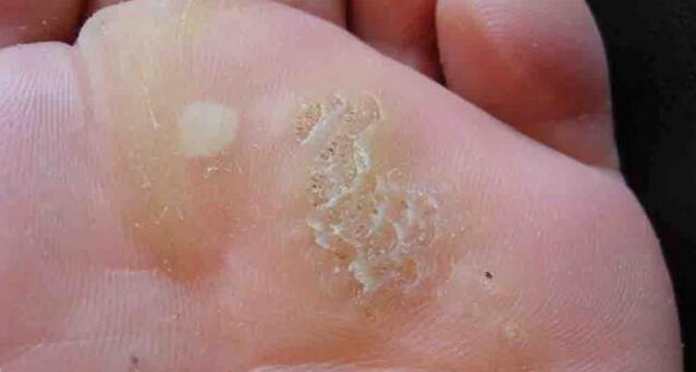 得了皮肤病千万别碰这些药,别把体癣当湿疹