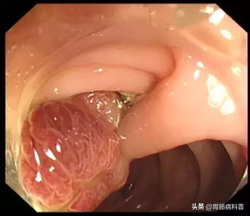 只要是肠息肉都要割掉吗,医生肠息肉切除后怎么处理伤口