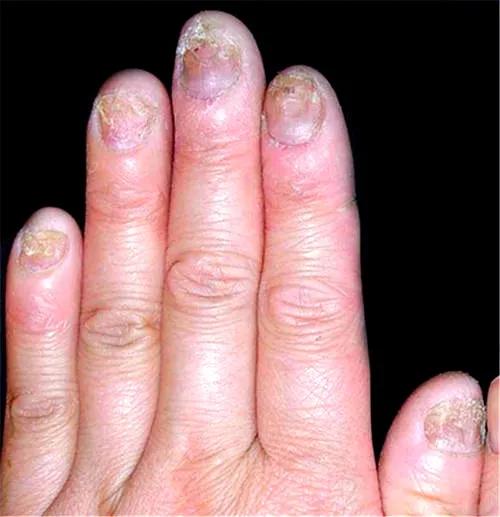 为什么得灰指甲?得了灰指甲怎么治?听医生说
