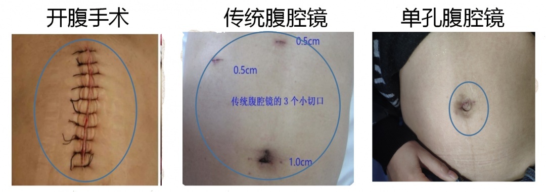 女性单孔腹腔镜手术,贵州省单孔腹腔镜