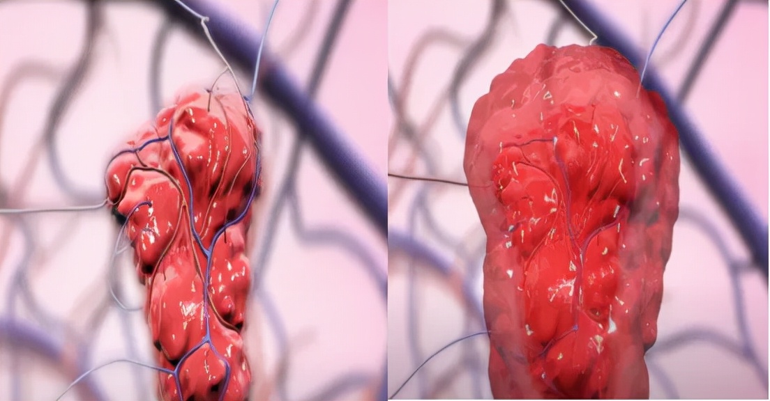 颅内海绵状血管瘤能治好吗,什么是颅内海绵状血管瘤