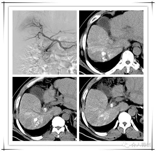 原发性肝癌伴门静脉癌栓能活多久,原发性肝癌介入治疗及进展