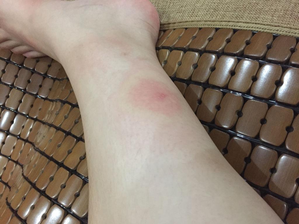 板层状鱼鳞病怎么引起,板层状鱼鳞病是单基因吗