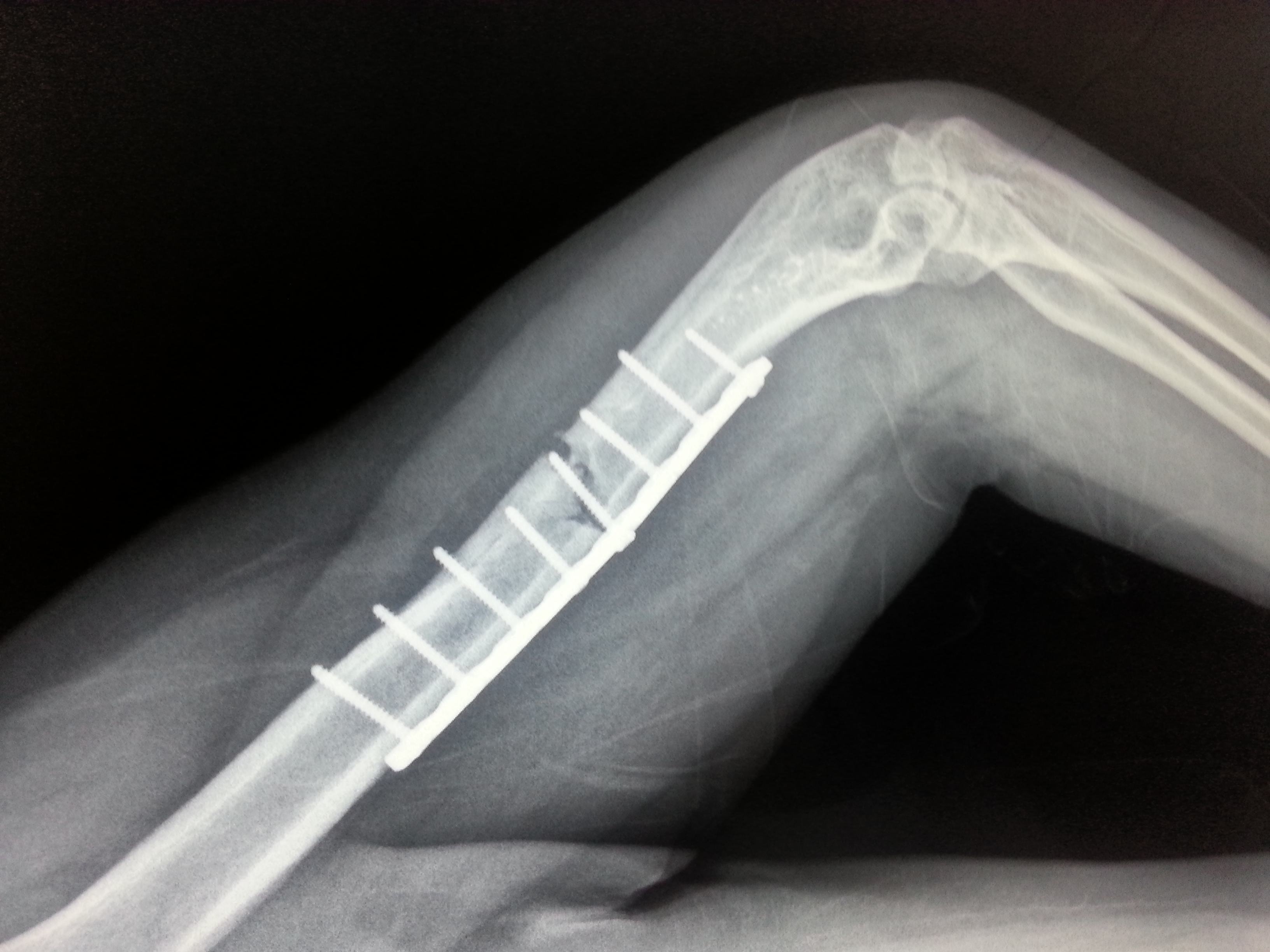 关于骨折有关情况的说明,了解骨折知识