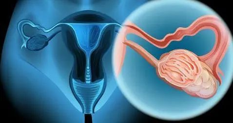 23岁女子一月来五次月经，查出宫颈癌，家长痛哭：是男人害的