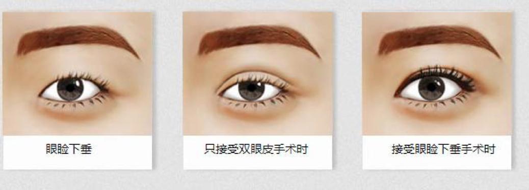 做双眼皮手术有风险呢,一般双眼皮手术价格表