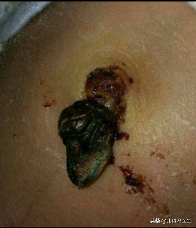 新生儿脐炎首选抗生素,新生儿脐炎症状和表现