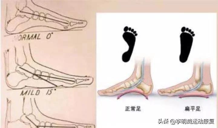 足外翻能不能治愈,足外翻能自己长好吗