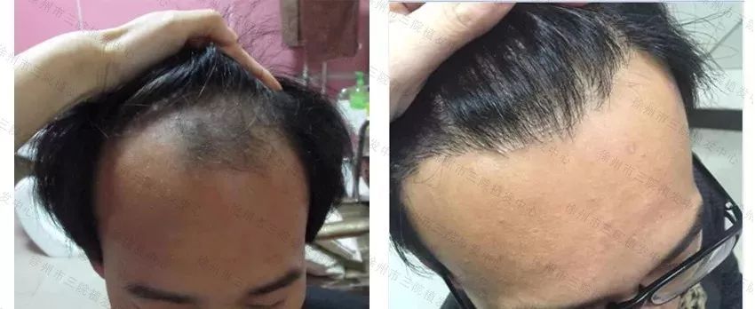 脱发恢复会经历一段暴脱期吗,脱发怎么恢复最快最有效的方法