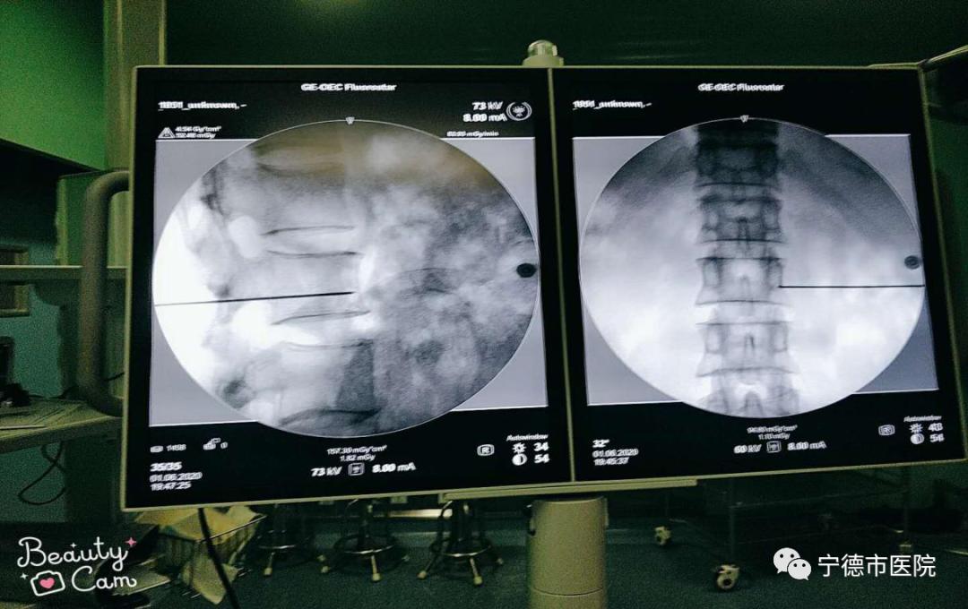 宁德市医院疼痛科开展首例C型臂引导腰交感神经阻滞术