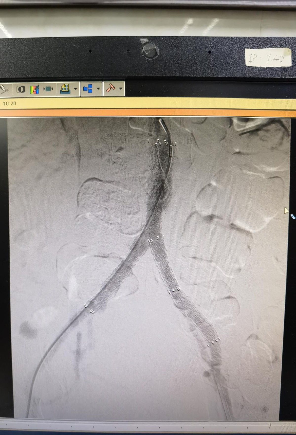 下肢动脉硬化闭塞中医什么科,老人下肢动脉硬化闭塞截肢