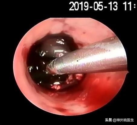 球囊扩张血肿怎么办,经皮穿刺脑血管腔内球囊成形术