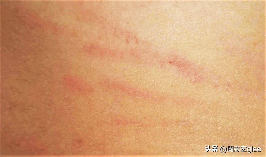 治疗蚊子咬后奇痒的药,跟蚊子咬的疙瘩一样奇痒无比