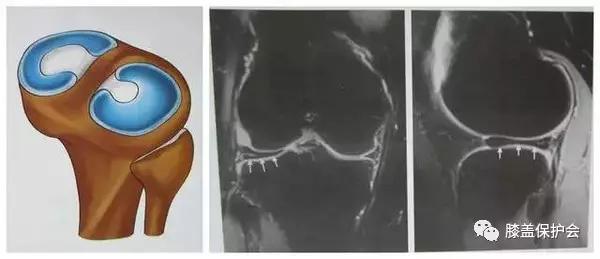 半月板受伤的理由,半月板最怕的动作别再做了